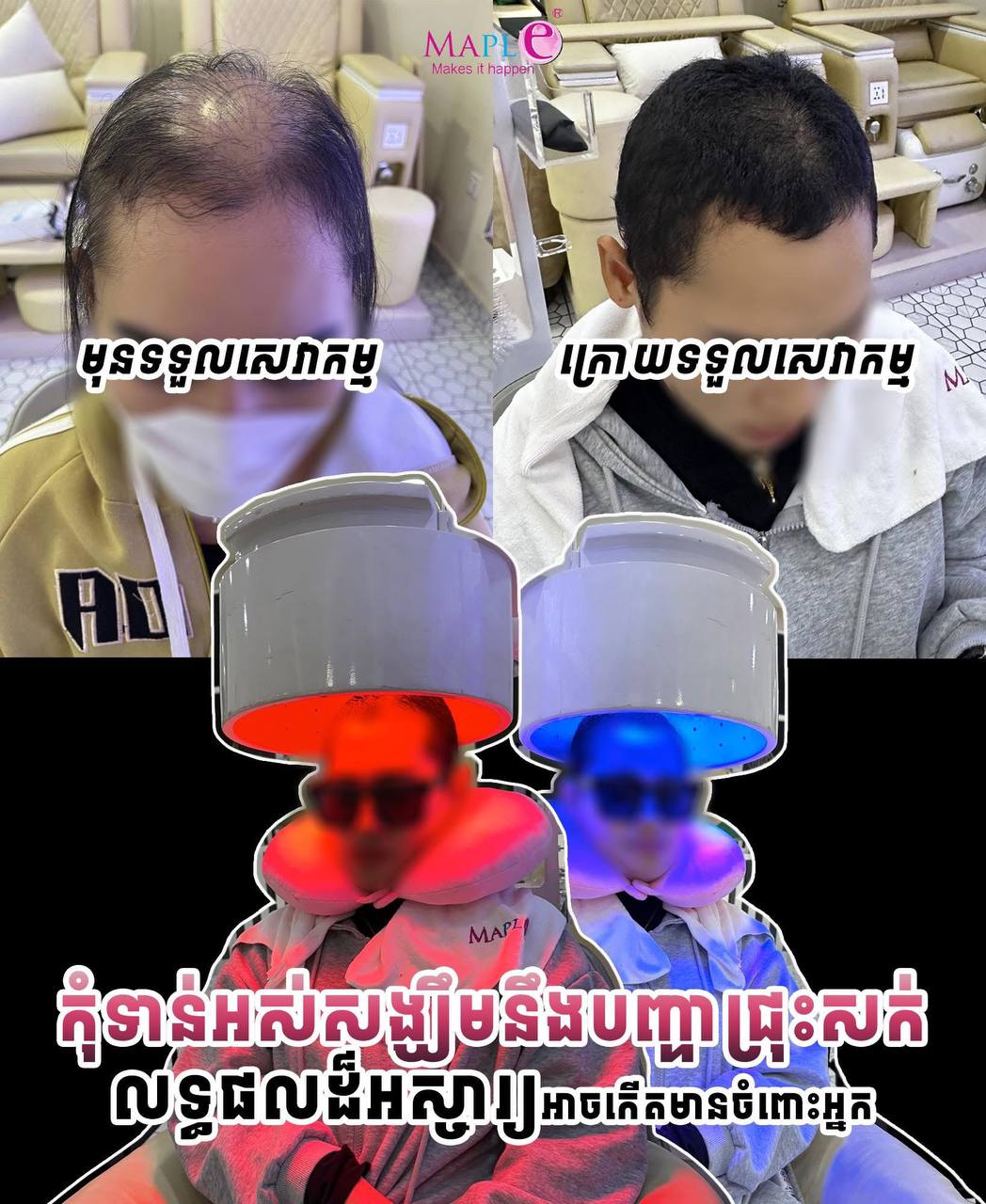 Laser Hair Growth Therapy
